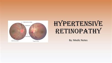 Hypertensive Retinopathy Signs Pathophysiology Youtube