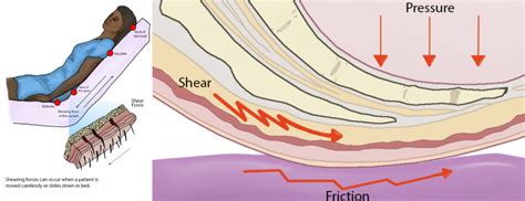 pressure injuries nursing fundamentals