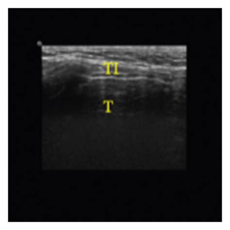 Thyroid Ultrasound Standard Plane Images Ti Represents Thyroid