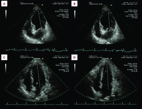 Echocardiogram Showing Normal Left Ventricular Ejection