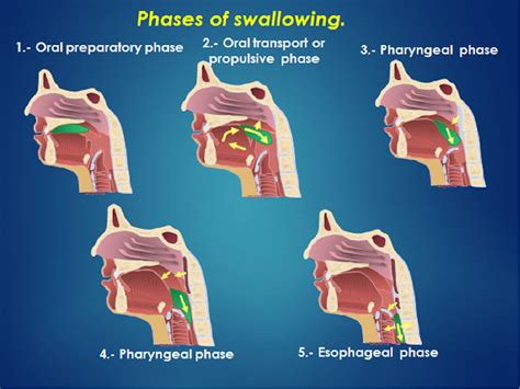 Figure 1 From Oropharyngeal Videofluoroscopic Swallow Study A How To