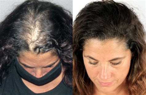 Hair Transplant Before/After Results for Women - Bosley Hair Transplant