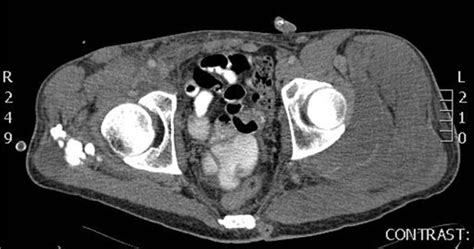 Muscle Localization Of Heterotopic Ossification Following Spinal Cord Injury The Spine Journal