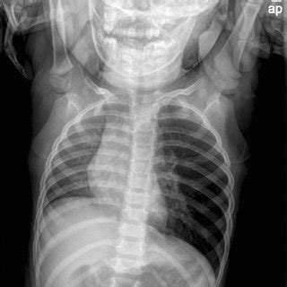 Simple Chest X Ray AP Left Hyperinflated Thorax And Mediastinum