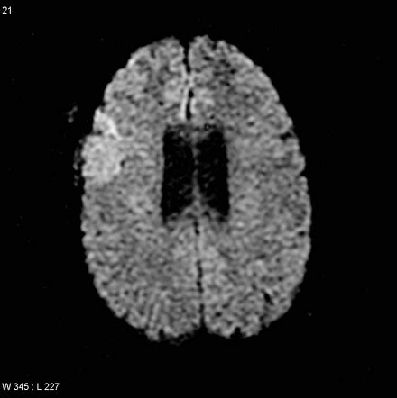 Meningioma With Extension Through Skull Vault Image Radiopaedia Org