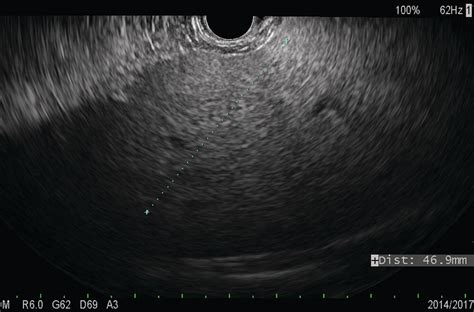 How To Do Endoscopic Ultrasound‐guided Liver Biopsy Radiology Key