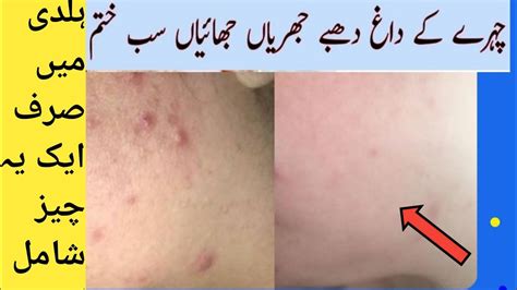 Acne And Pimple Marks Removal At Home Face Par Dano Ki Nishan Khtam