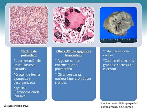 Clasificaci N De Las Neoplasias Benignas Y Malignas