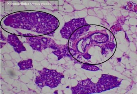 Histological Section Of The Breast Tissue Of Dmba Induced Breast Cancer