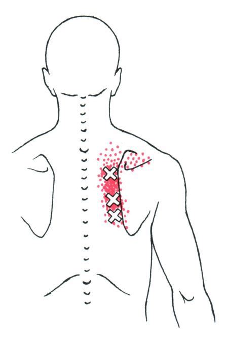 Rhomboid | The Trigger Point & Referred Pain Guide