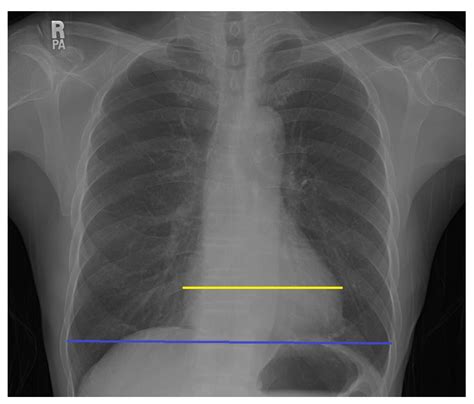 Aortic Arch Calcification Treatment - Pregnant Health Tips