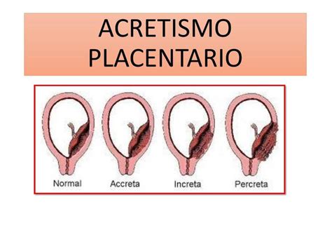 Acretismo Placentario Enfoque General Placenta Acreta Acretismo Udocz