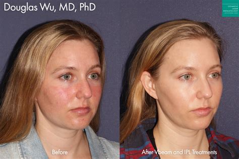 What To Expect Before During And After Ipl Photofacial Treatment