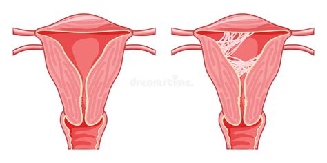 Set Of Asherman Syndrome Female Reproductive System Scar Tissue