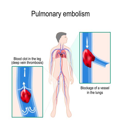 Deep Vein Thrombosis