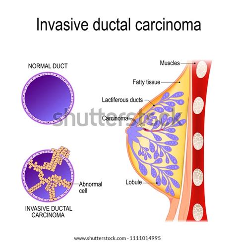 Invasive Ductal Carcinoma Crosssection Scheme Mammary Stock Vector