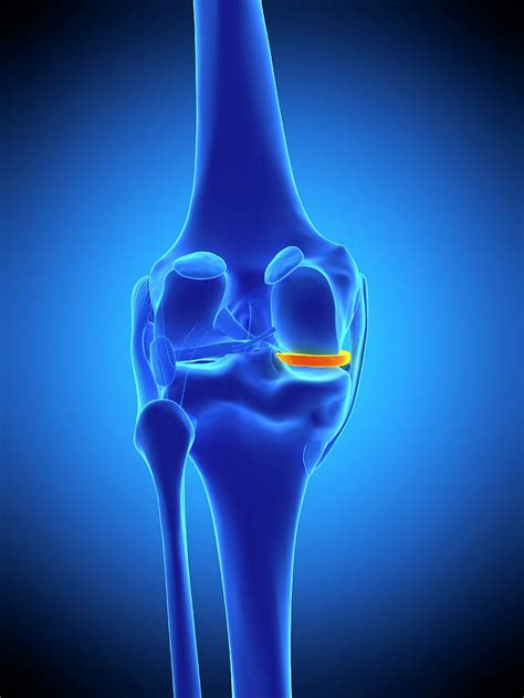 Knee Meniscus Photograph By Sebastian Kaulitzkiscience Photo Library