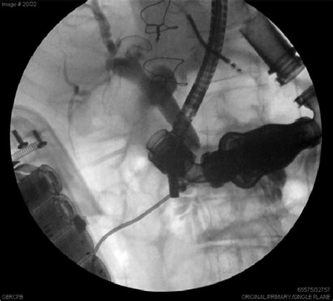 Ercp Images Illustrate The Common Bile Duct With Distal Stricture