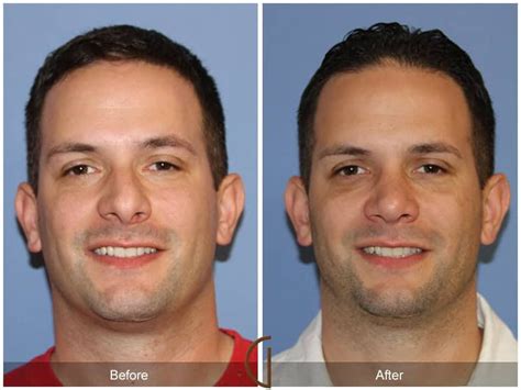 Male Rhinoplasty Before After Photos From Dr Kevin Sadati