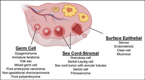 Ovarian Cancer Gmka Global Medical Knowledge Alliance