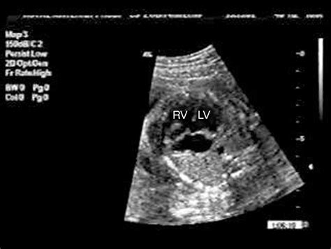 Atrioventricular septal defect: from fetus to adult | Heart