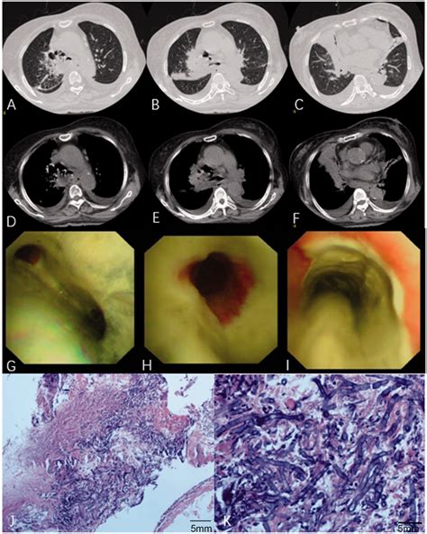 The Details Of Chest Computed Tomography Ct Bronchoscopy And