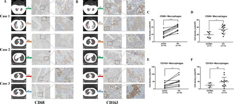 Assessment Of Cd68 Tumor Associated Macrophages Tams And Download Scientific Diagram