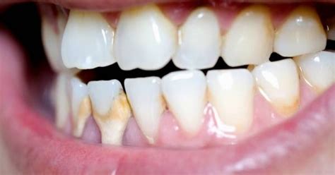 8 Easy Methods For Dental Calculus Removal At Home! Guide 2025