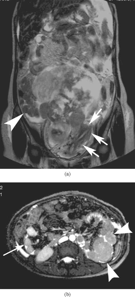 Figure 2 From MR And CT Findings Of Leiomyomatosis Peritonealis