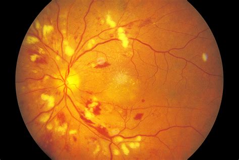 Clinical Picture Hypertensive Retinopathy Gponline