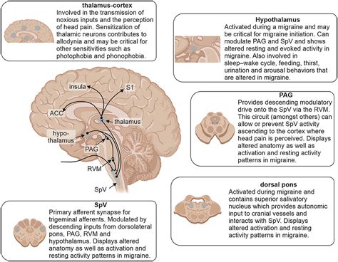 Migraine Headache Diagram