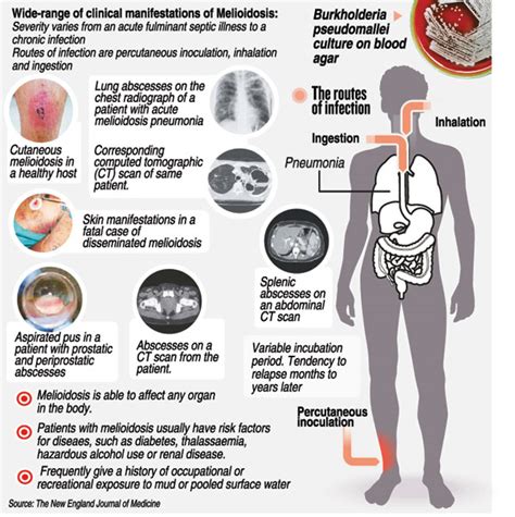 Melioidosis A Deadly Bug Hiding Under Another Identity The Sunday Times Sri Lanka