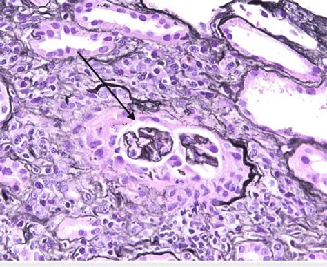 Light Microscopy Of Renal Biopsy Two Of Six Non Sclerotic Glomeruli