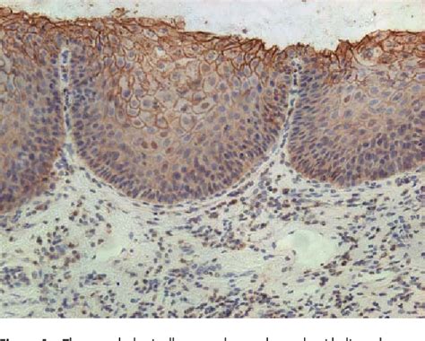 Figure 1 From Clinical Relevance Of Fas Expression In Oesophageal