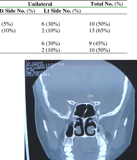 Figure 1 From Variations Of Sphenoid Sinus And Their Impact On Related