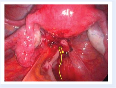 Figure 2 From Surgical Management Of Deep Infiltrating Endometriosis Of