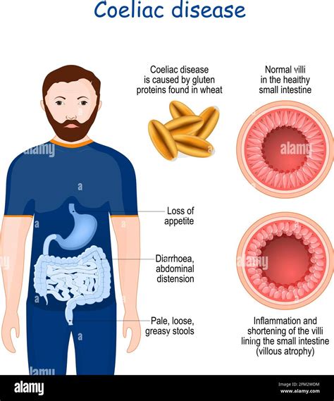 Symptoms Of Small Intestine Problems