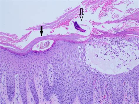 histopathologic examination revealed  scabetic mite   stratum
