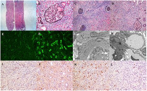 Frontiers Case Report Predominant Tubulointerstitial Lupus Nephritis