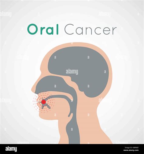 Mouth Cancer Stock Photos Mouth Cancer Stock Images Alamy