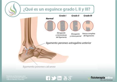 Sabes Qu Es Un Esguince De Tobillo Y Cuales Son Sus Grados Seg N La