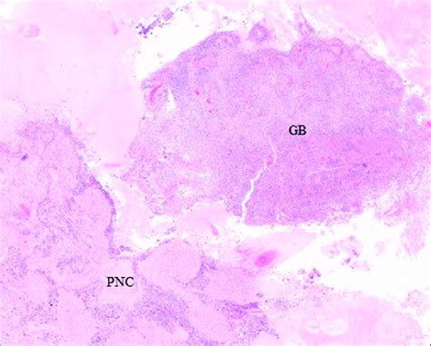 Hematoxylin Eosin Stain Showing Both Tumor Components And Transition