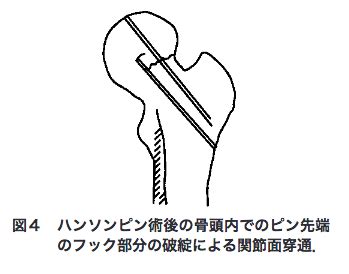 リハが知るべき大腿骨頚部骨折の骨接合術（CCS (CCHS)、ハンソンピン）の特徴と違い！ | 自分でできるボディワーク