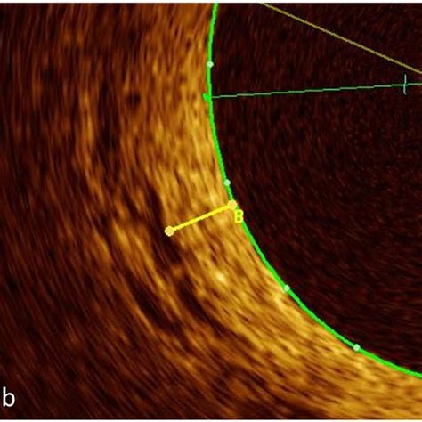 Examples Of Pulmonary Arteries In Patients With Pah Limited And Good Download Scientific