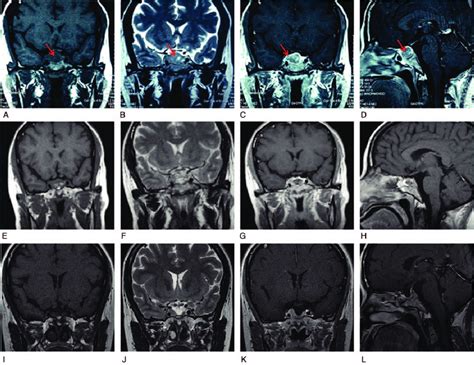 MRI scans of the patient with ganglioglioma. A-D, MRI scan before ...