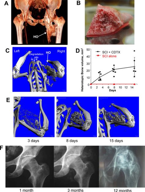 Heterotopic Ossification Requires Both Sci And Local Inflammation In A Download Scientific