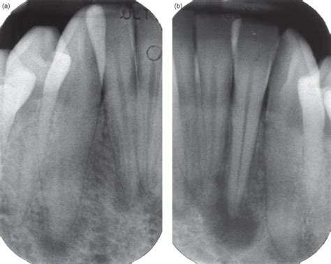 radiolucencies pocket dentistry