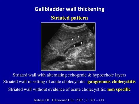 Ultrasound Of Acute And Chronic Cholecystitis