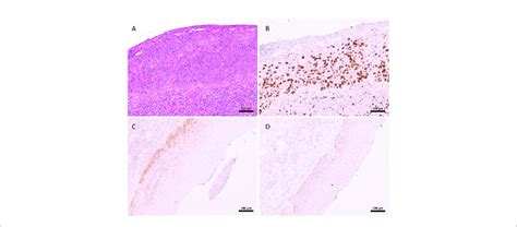 | Features of Penile intraepithelial neoplasia in the glans of a ...