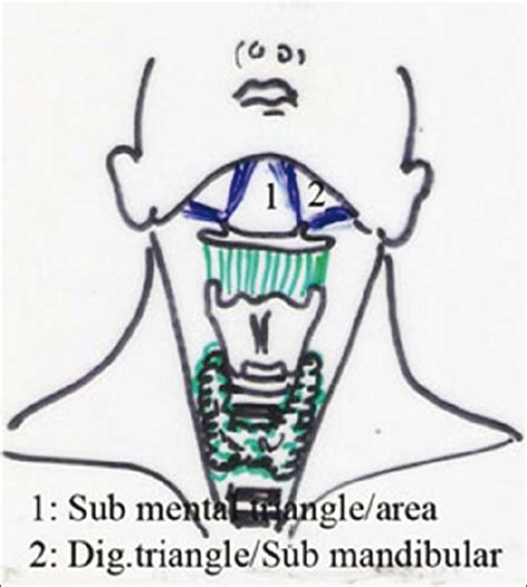 Submental and submandibular area after dissection | Download Scientific ...